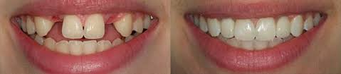 implantaciya_zubov2